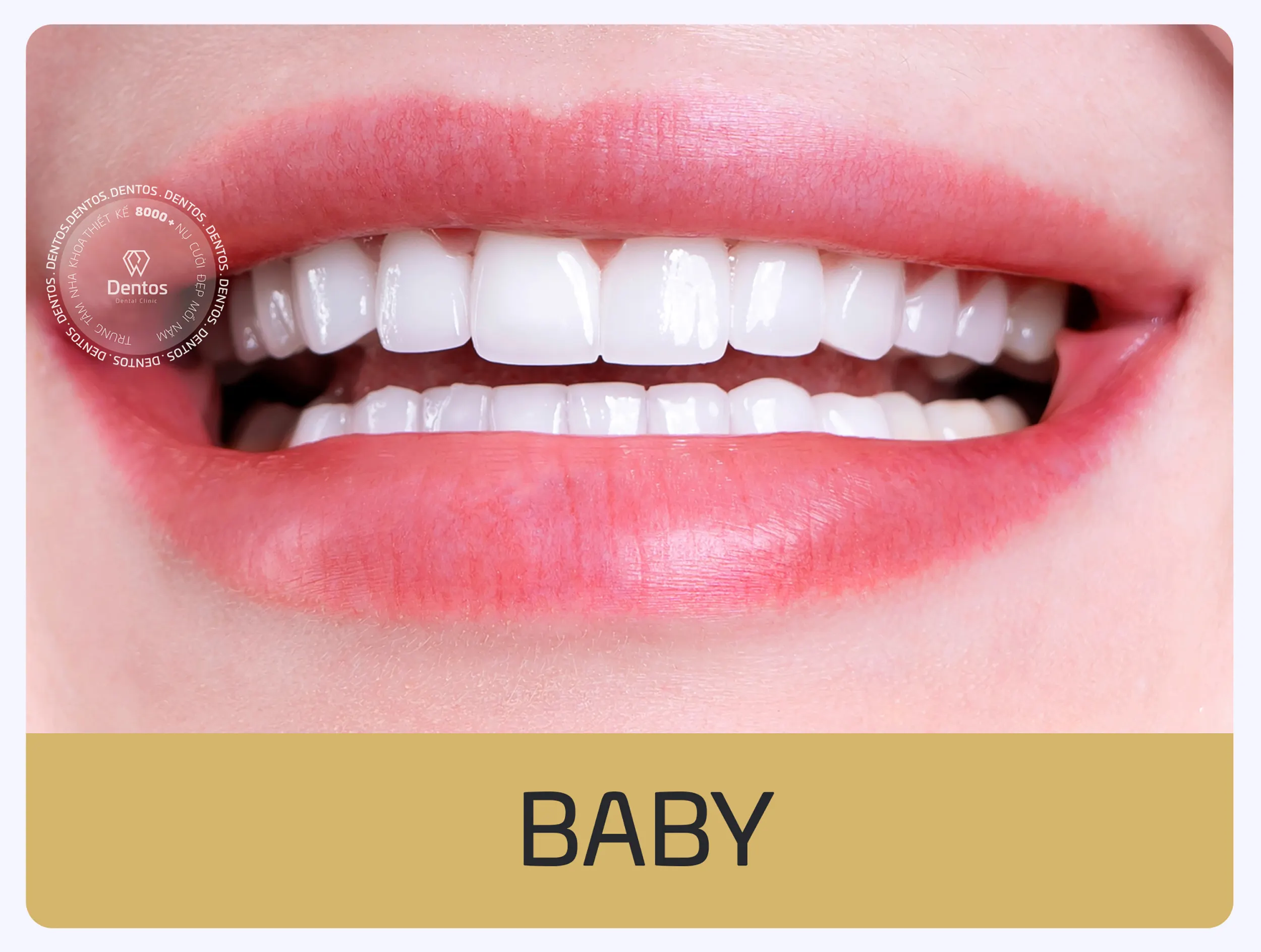 Bọc răng sứ phong thủy Dentos - Dáng răng sứ baby