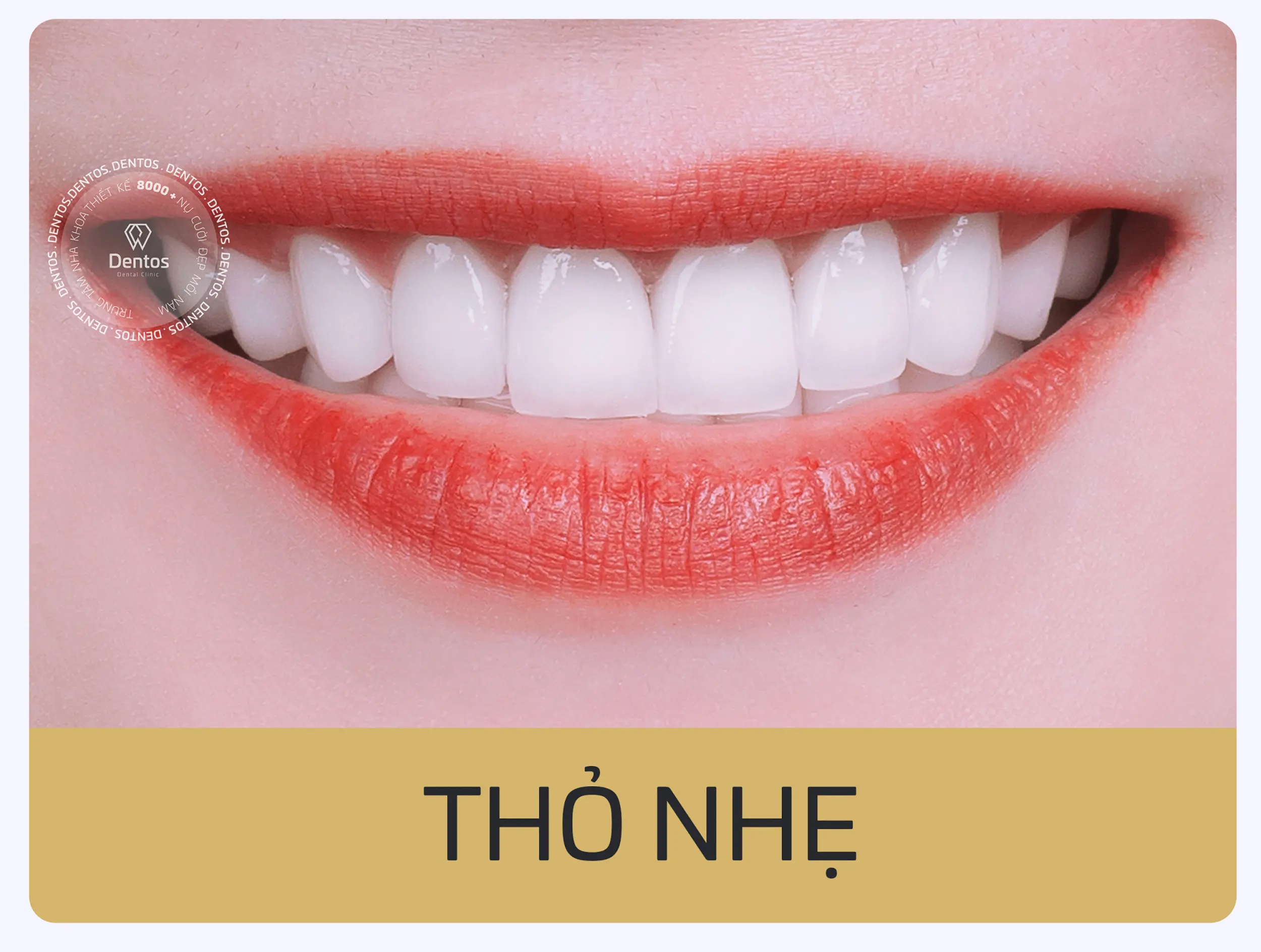 Mẫu răng sứ dáng Thỏ Nhẹ