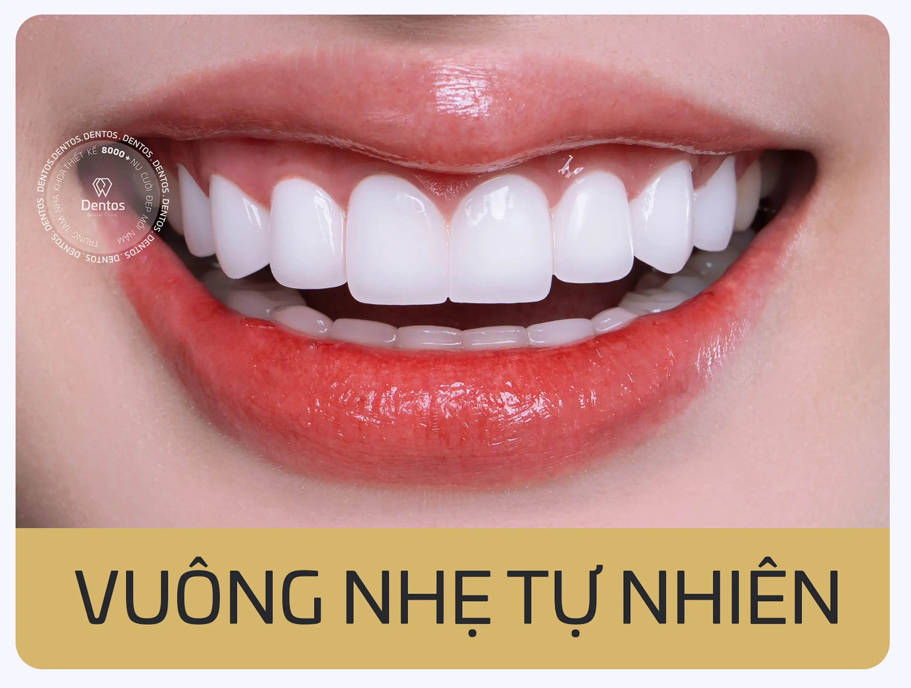 Các dáng răng sứ đẹp & thời trang - Dáng răng sứ vuông nhẹ tự nhiên