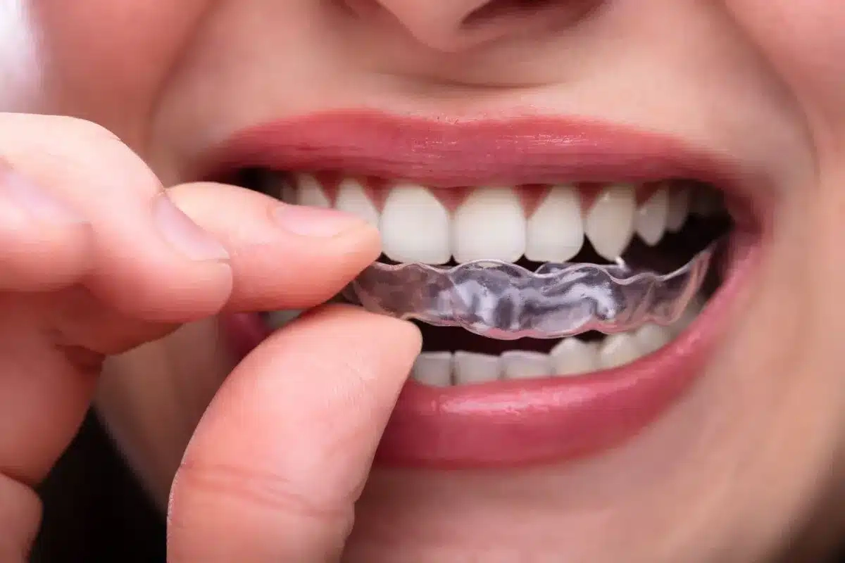 Đeo dụng cụ bảo vệ răng khi ngủ nếu bạn có thói quen nghiến răng