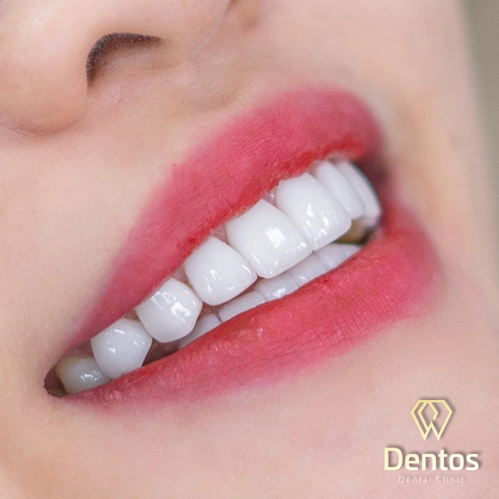 Quy trình bọc lại răng sứ tại nha khoa Dentos thường chỉ cần 2 lần hẹn
