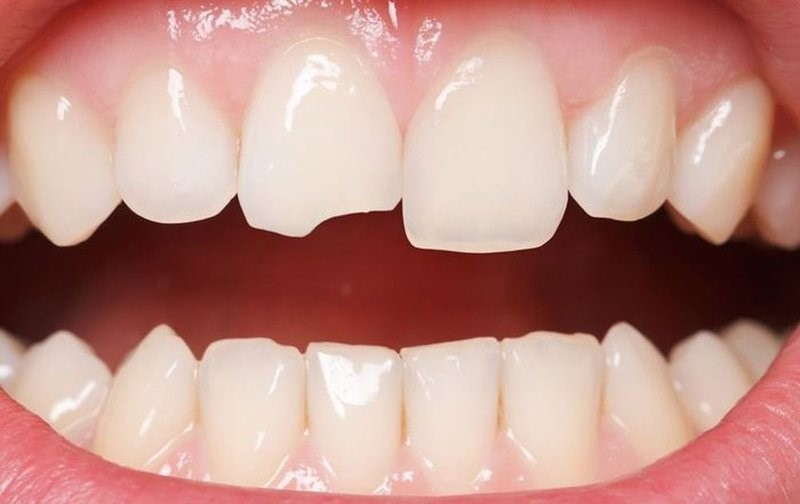 Răng sứ bị mẻ vỡ thường do lực tác động mạnh từ bên ngoài (Nguồn: St)