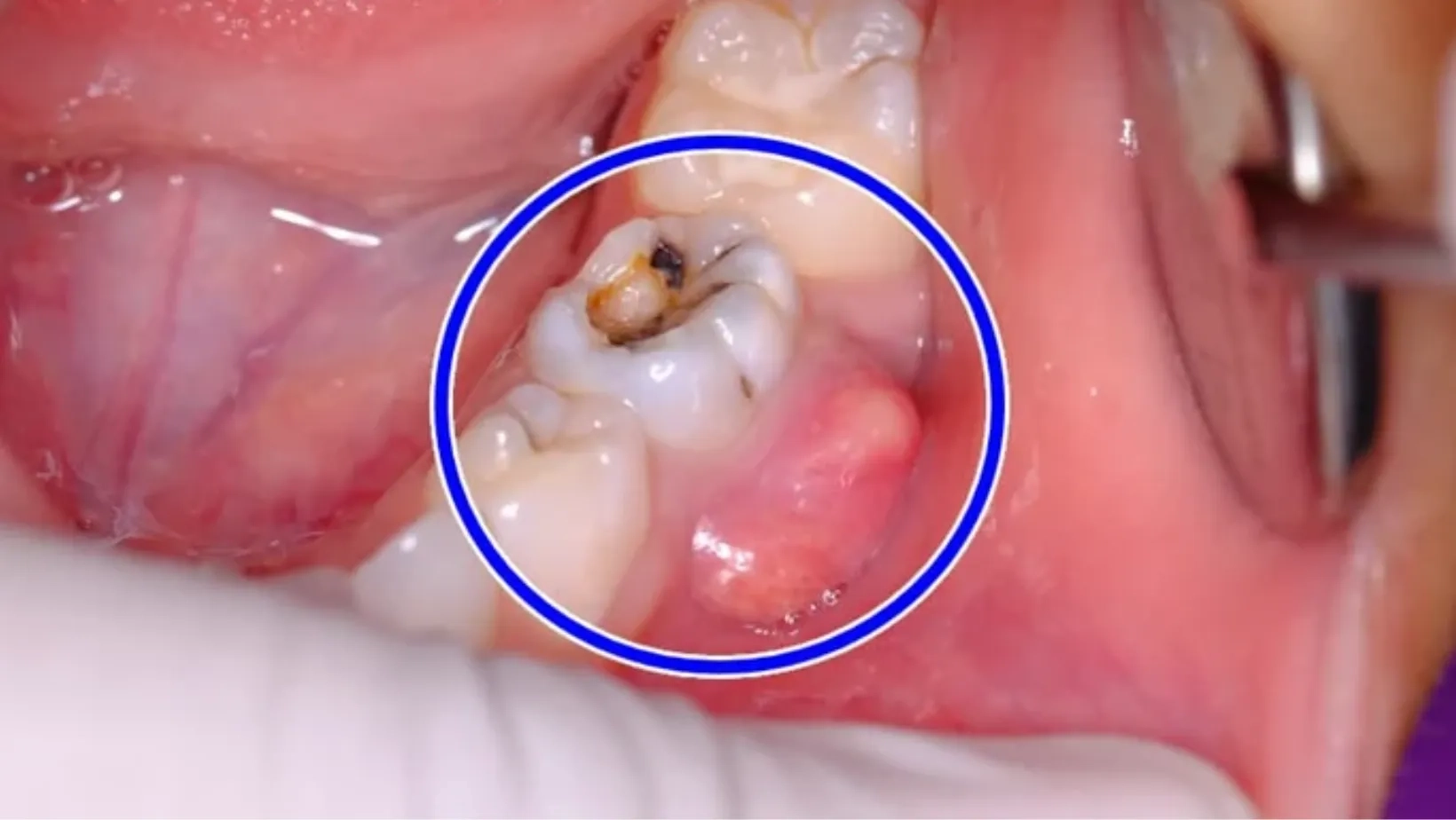 Sưng nướu, có mụn mủ là dấu hiệu nhiễm trùng đã lan xuống chóp răng (Nguồn: St)