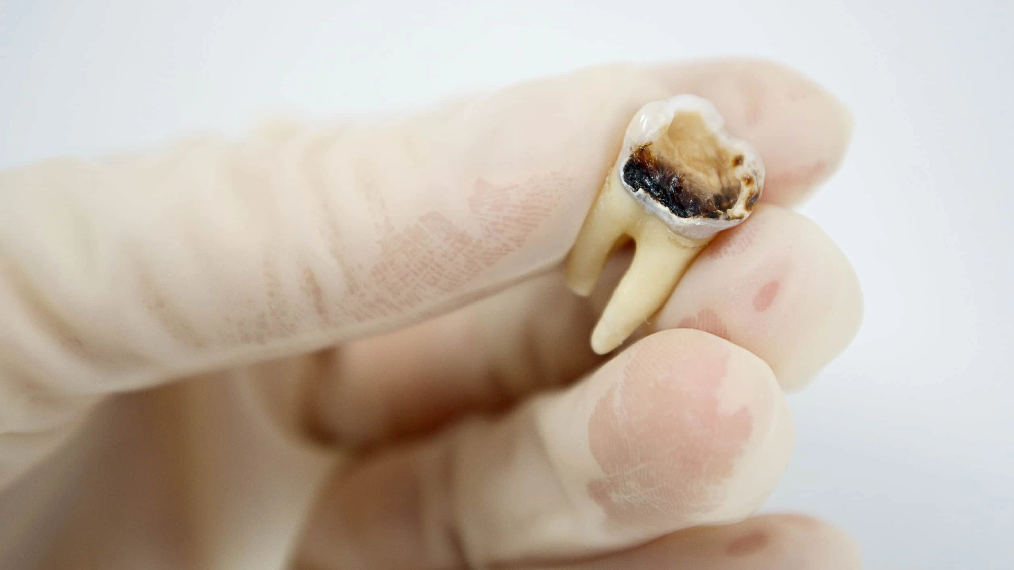 Răng vỡ lớn không đủ mô răng để làm trụ cần nhổ bỏ và xem xét Implant hoặc cầu răng