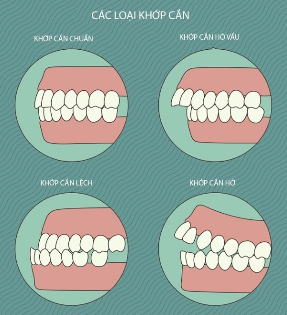 Những trường hợp không nên bọc răng sứ - Răng xấu do cấu trúc xương hàm