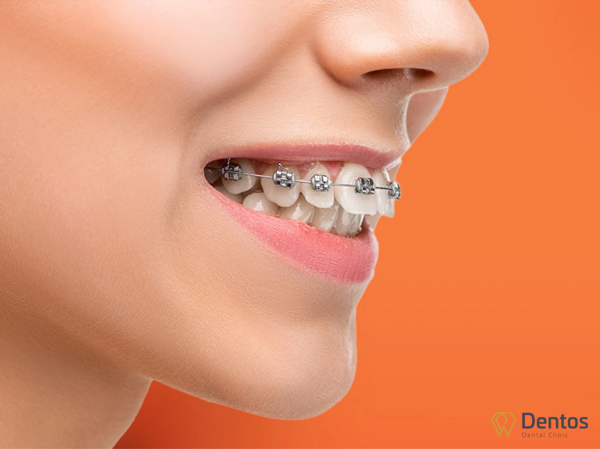 Niềng răng là sử dụng các khí cụ chuyên dụng nhằm điều chỉnh vị trí của các răng