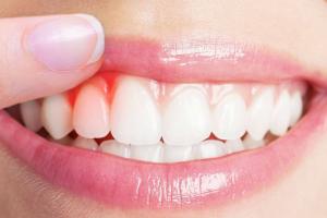 Các trường hợp răng mắc nha chu nghiêm trọng cần được lấy tủy bọc răng sứ