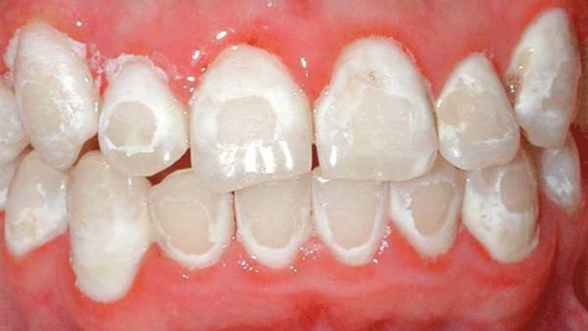 Phủ sứ nano hoàn toàn không phải là kỹ thuật bọc răng sứ hay dán sứ Veneer