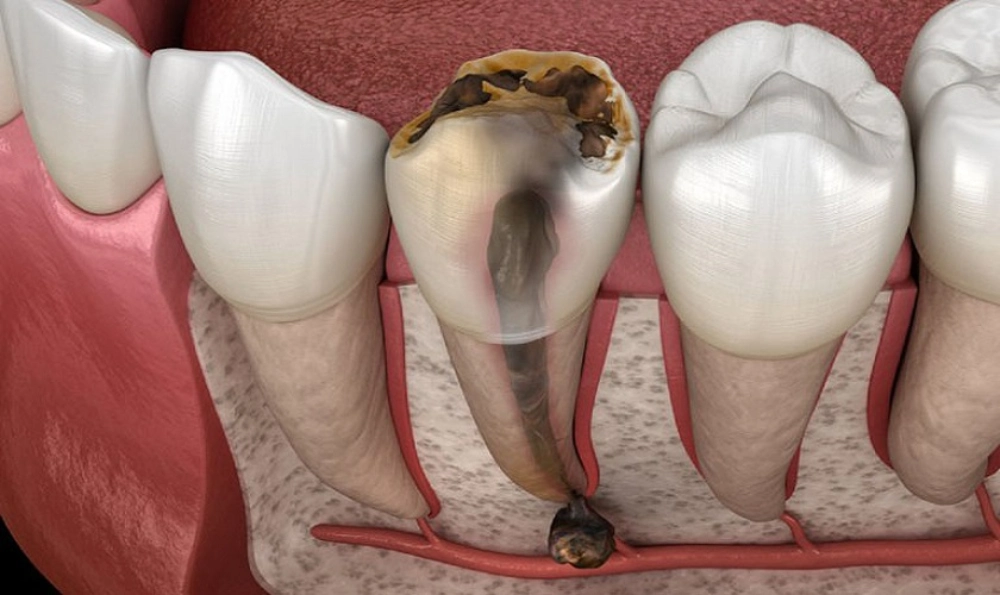 Làm răng sứ sai cách có nguy cơ tổn thương răng thật và tủy răng