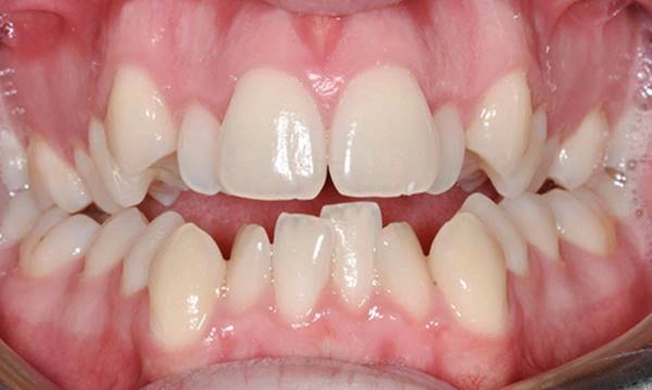 Răng sai lệch nặng sẽ đòi hỏi mài răng thật rất nhiều và tiềm ẩn nguy cơ hỏng tủy