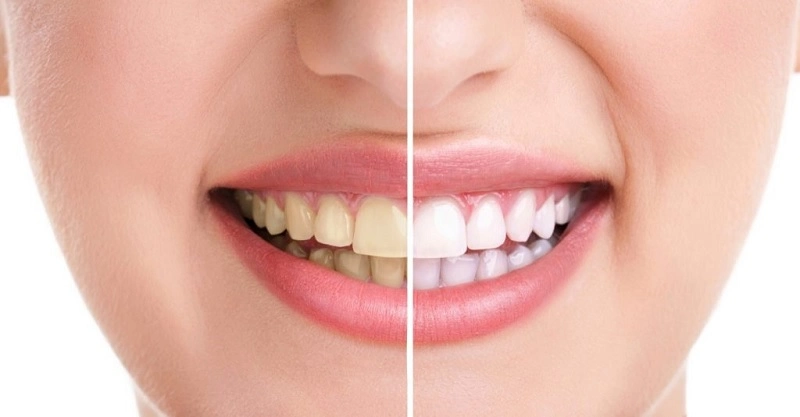 Tẩy trắng răng phù hợp với các trường hợp răng ố vàng nhẹ