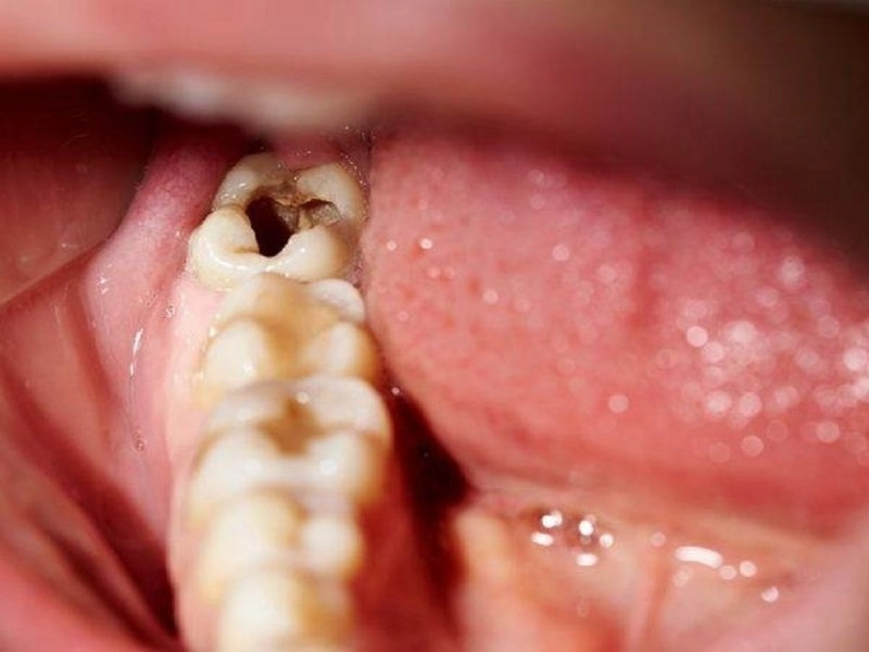 Bọc sứ thẩm mỹ đối với răng sâu, vỡ lớn 