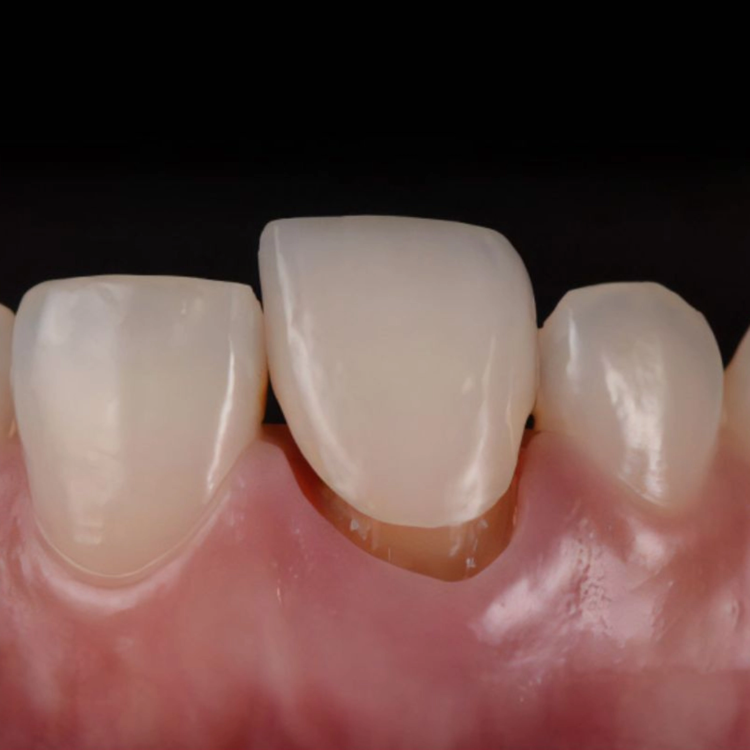 Kỹ thuật bọc răng sứ ban đầu không chuẩn khiến mão sứ bị hở ở phần cổ răng
