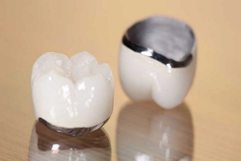 Giá bọc răng sứ kim loại dễ tiếp cận nhưng thẩm mỹ hạn chế