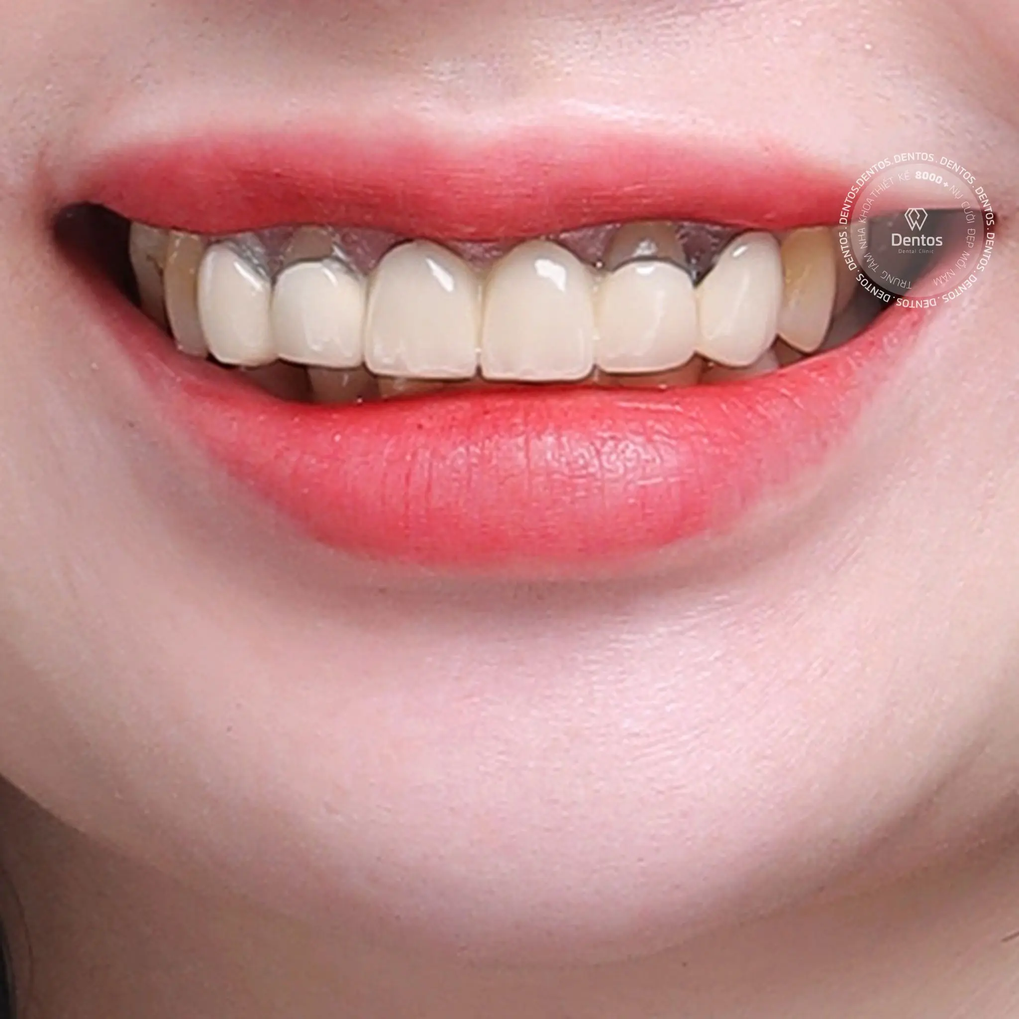 Mão sứ chế tạo không khít với cùi răng thật gây hở chân rang