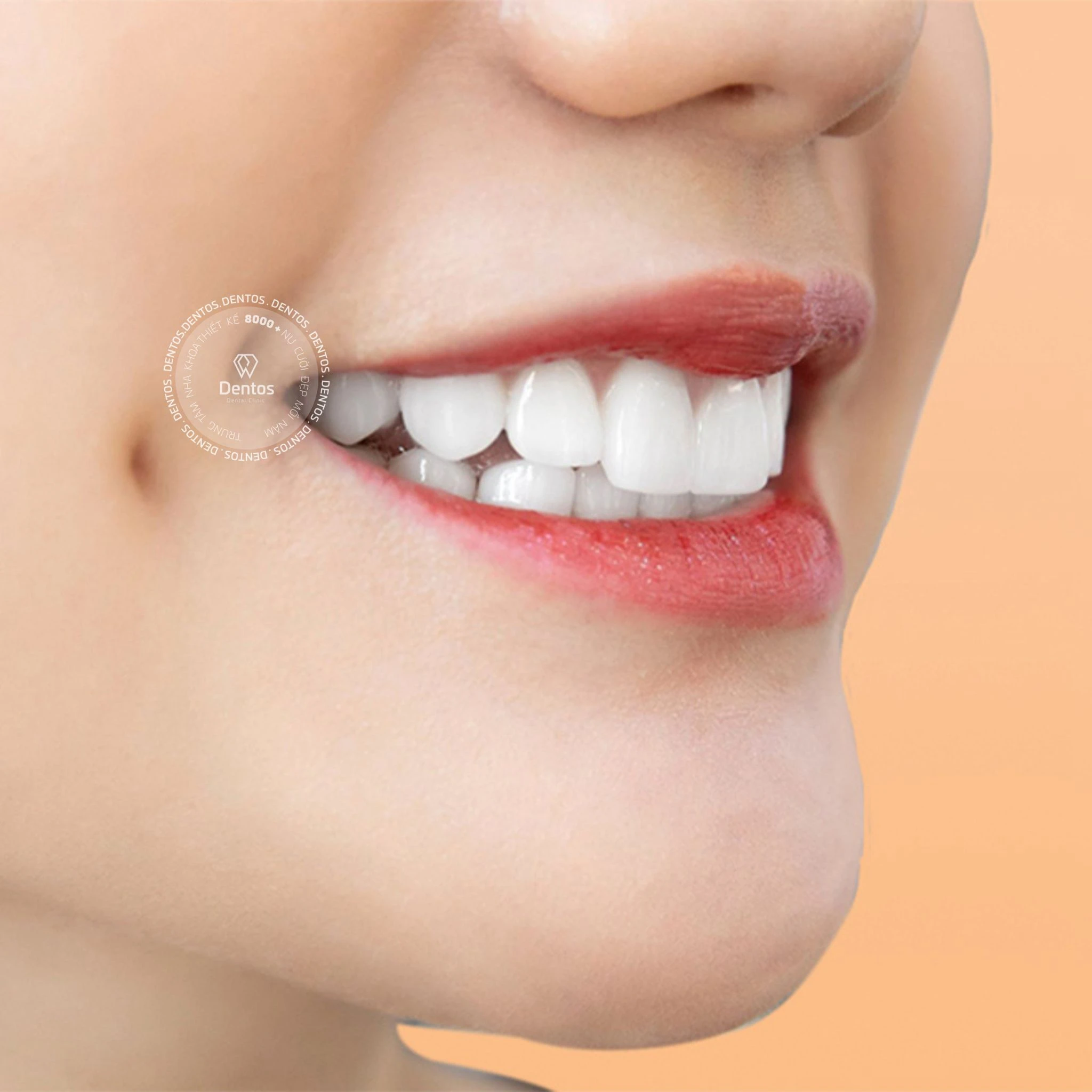 Răng sứ DDBio mang lại hiệu ứng trắng tươi rạng rỡ mà vẫn hài hòa với khuôn mặt