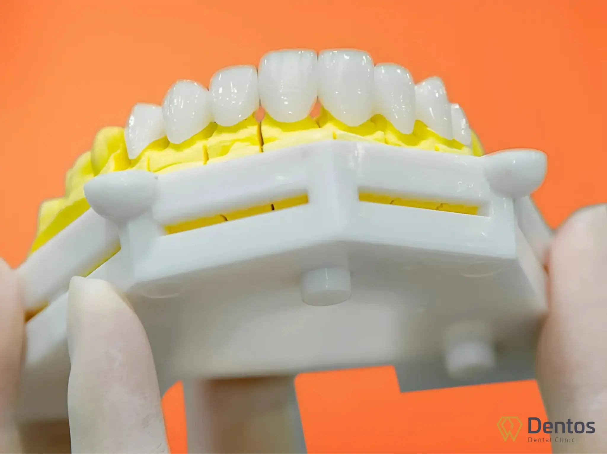 Bề mặt của răng toàn sứ rất nhẵn, có lớp chống bám màu, chống nhiễm khuẩn công nghệ cao