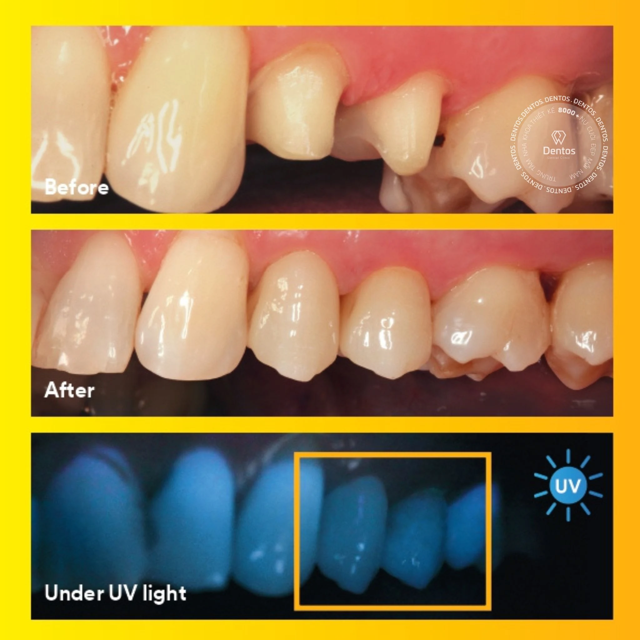 Răng sứ Lava Esthetic có khả năng phát huỳnh quang tự nhiên ngay trong cấu trúc phôi