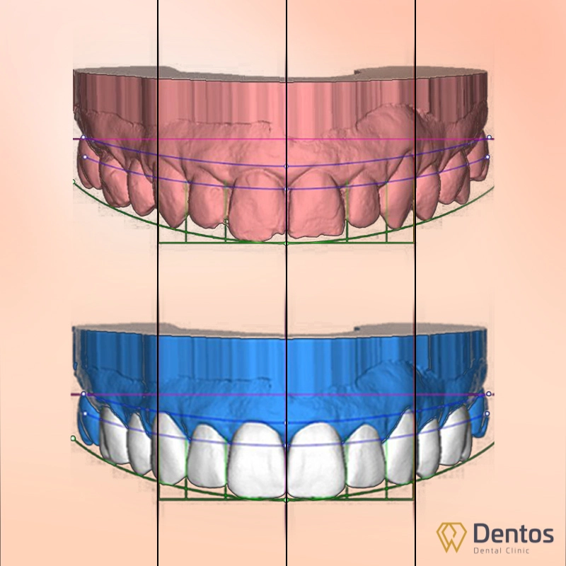 Thiết kế nụ cười bằng phần mềm DSD 3D theo khuôn mặt và nhân tướng học