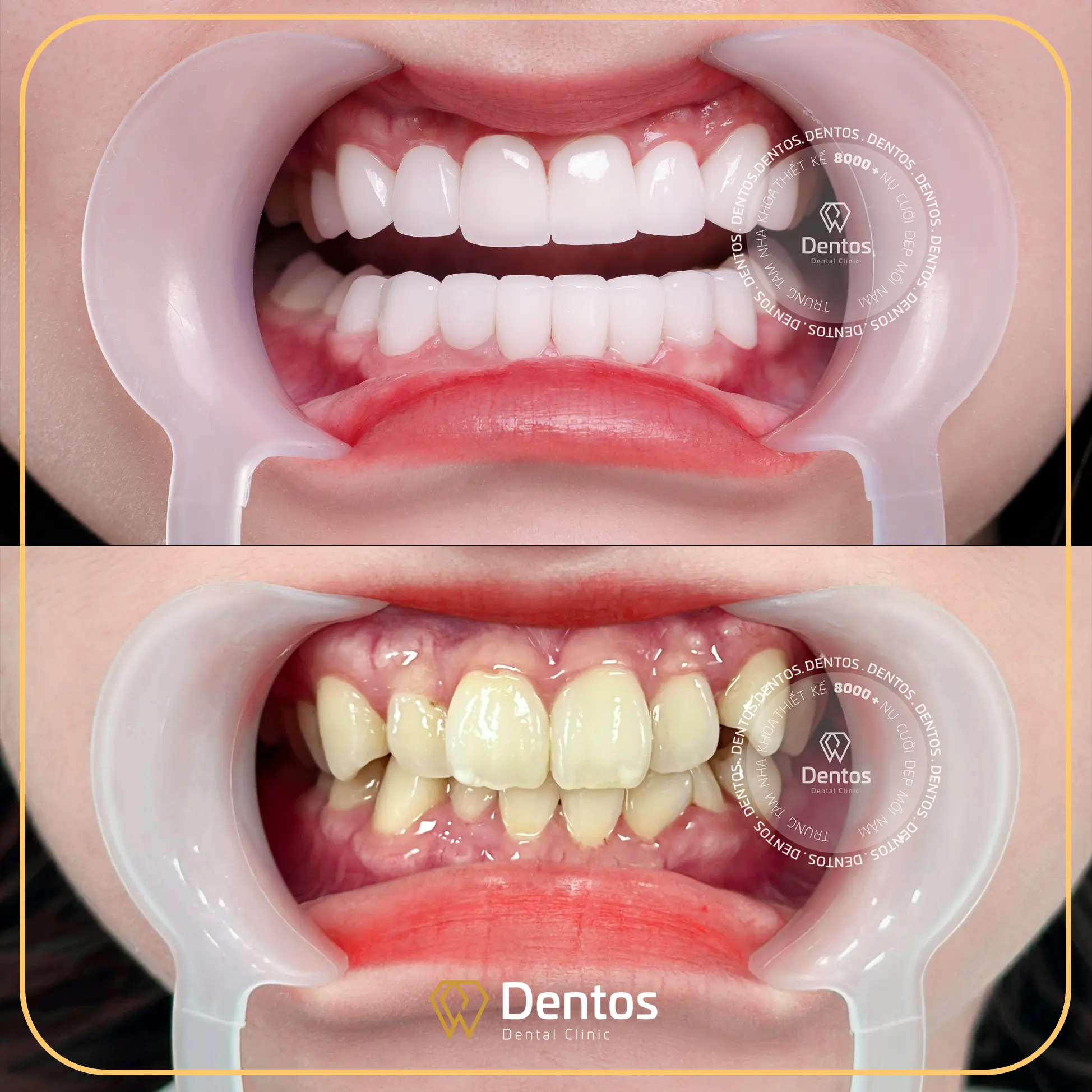 Bọc răng sứ sẽ giúp cải thiện hình dáng răng một cách hiệu quả
