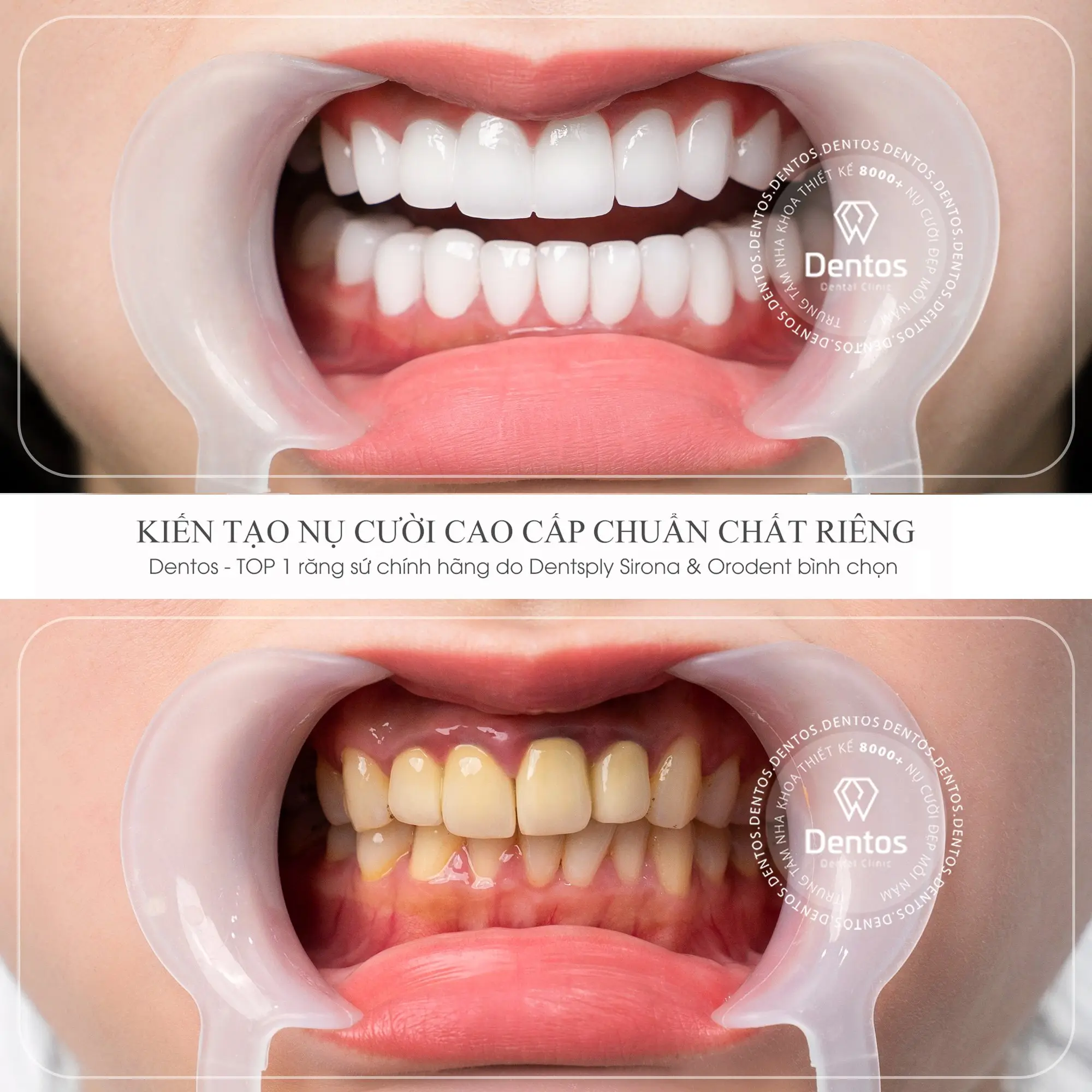 Răng sứ Cercon ht mang đến hiệu quả thẩm mỹ vượt trội với độ trong mờ cao hơn