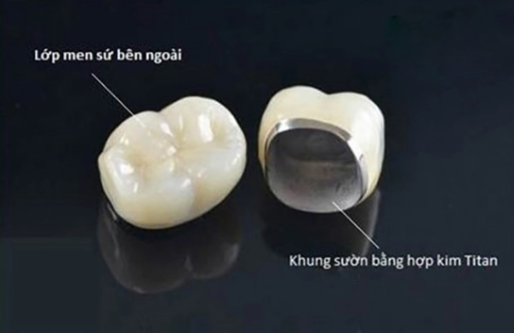 Răng sứ kim loại có cấu tạo gồm 2 lớp riêng biệt