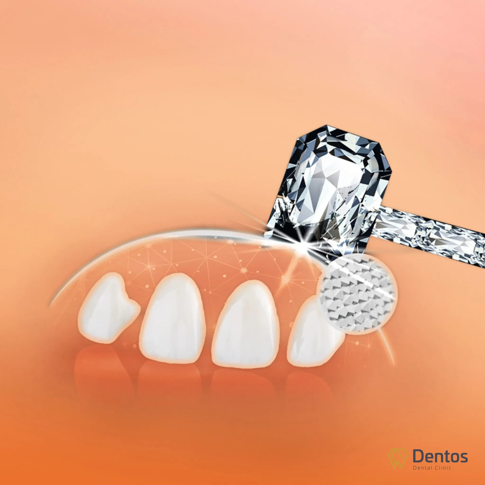 Răng toàn sứ Zirconia bền từ 15 đến 20 năm