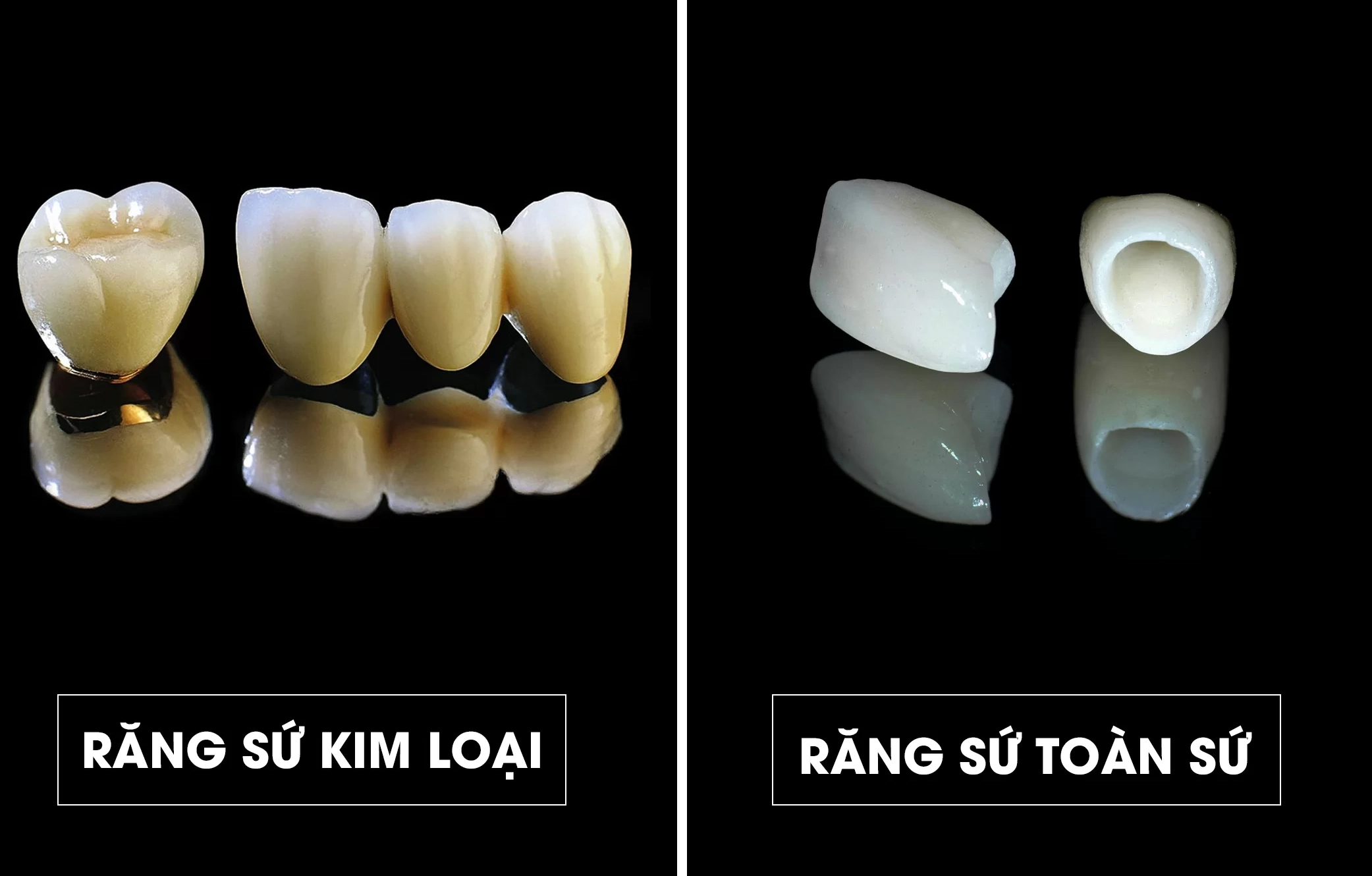Răng sứ kim loại và răng toàn sứ là 2 loại răng sứ phổ biến