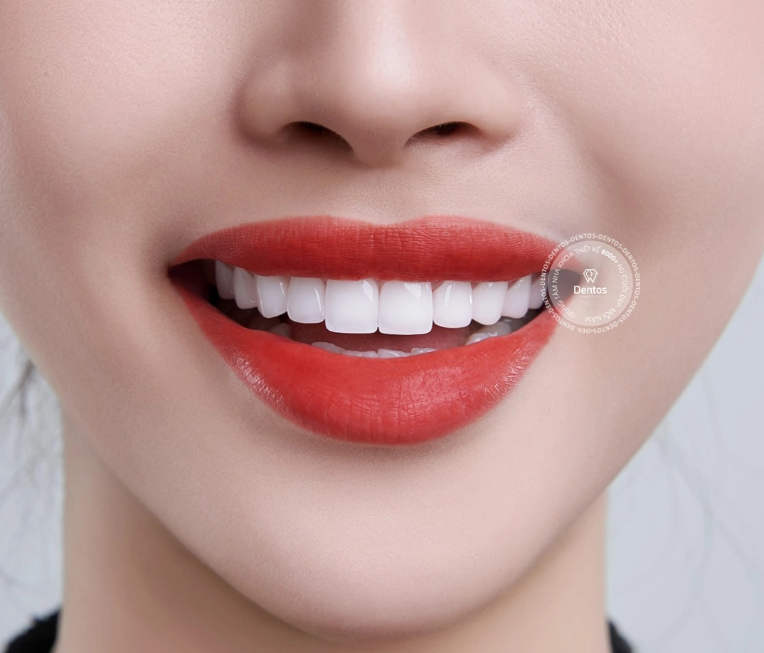 Răng sứ Zirconia sở hữu màu sắc trắng sáng tự nhiên