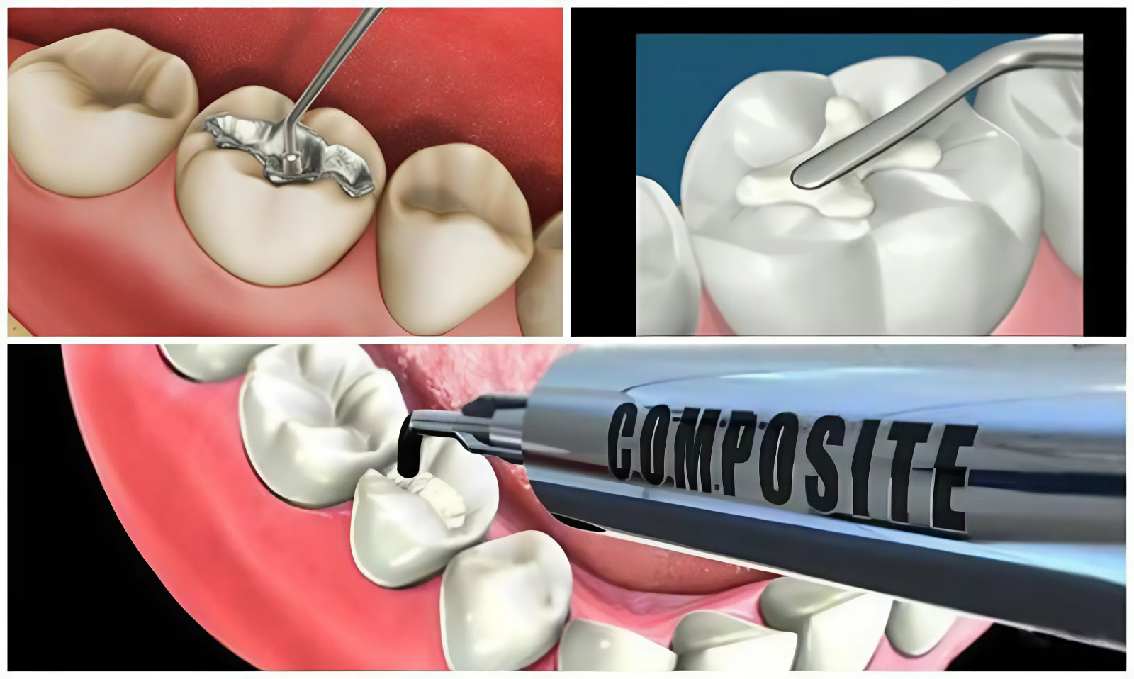 Hàn trám thẩm mỹ bằng composite nếu răng sứ bị mẻ, vỡ một phần nhỏ
