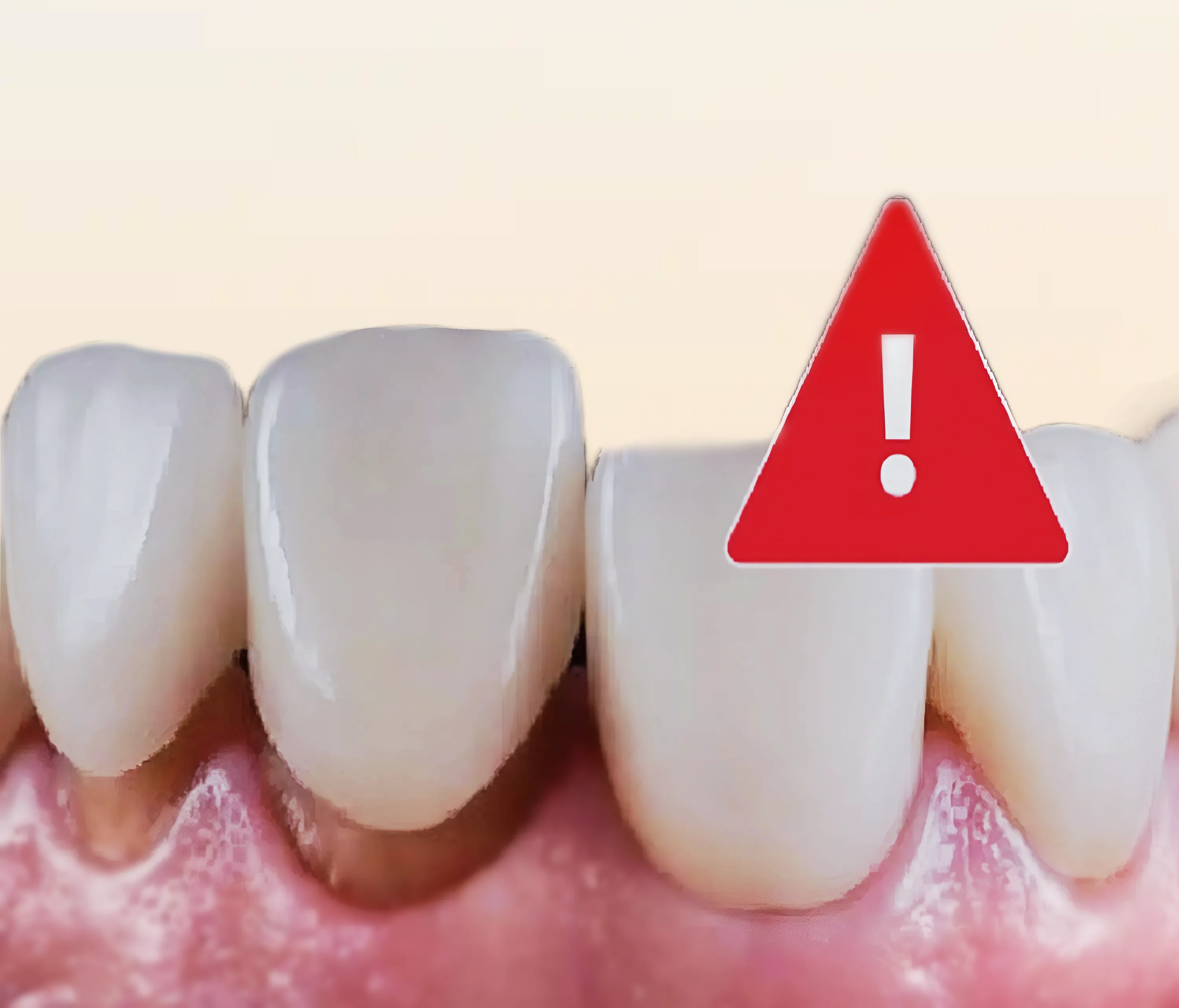 Răng sứ bị hở gây ra tình trạng hôi miệng