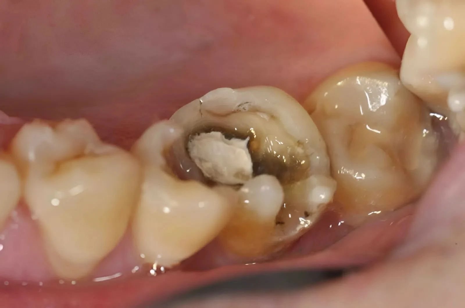 Răng sâu nặng, vỡ lớn mới cân nhắc bọc răng sứ để bảo vệ mô răng thật còn lại