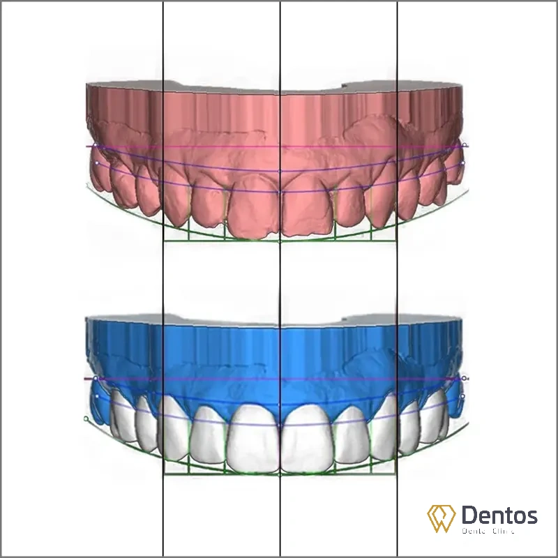 Công nghệ DSD 3D tiên tiến cho phép xem trước hình ảnh mô phỏng nụ cười tương lai
