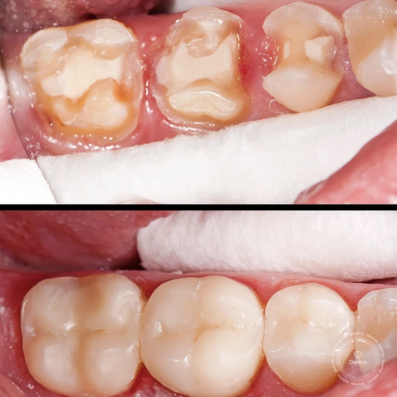 Trám răng là dùng Amalgam, vàng, xi măng, composite… để trám vào vị trí răng bị khuyết