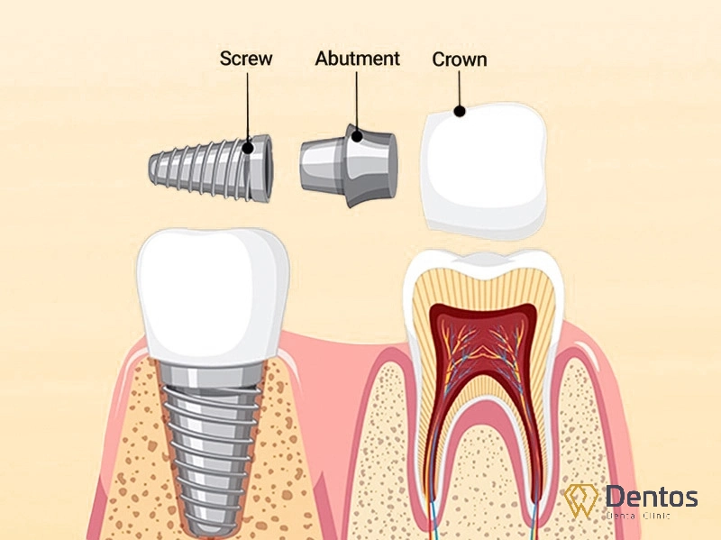 Cấy ghép implant là phương pháp phục hồi răng đã mất 