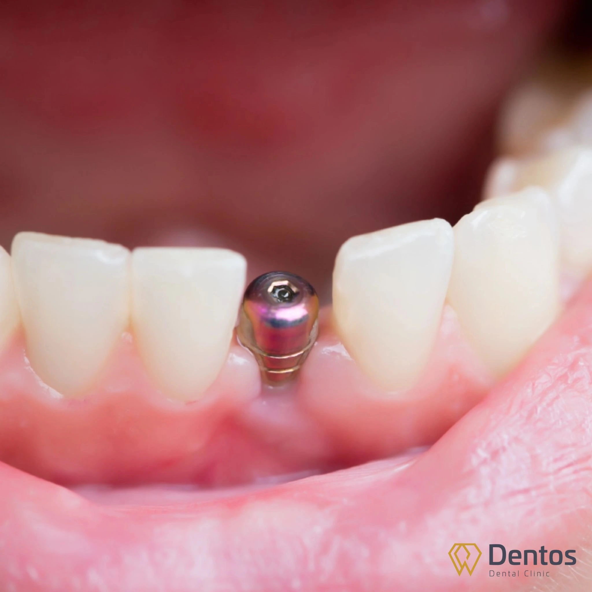 Phương pháp Implant sử dụng một trụ Implant làm từ Titanium để cấy trực tiếp vào mô xương hàm