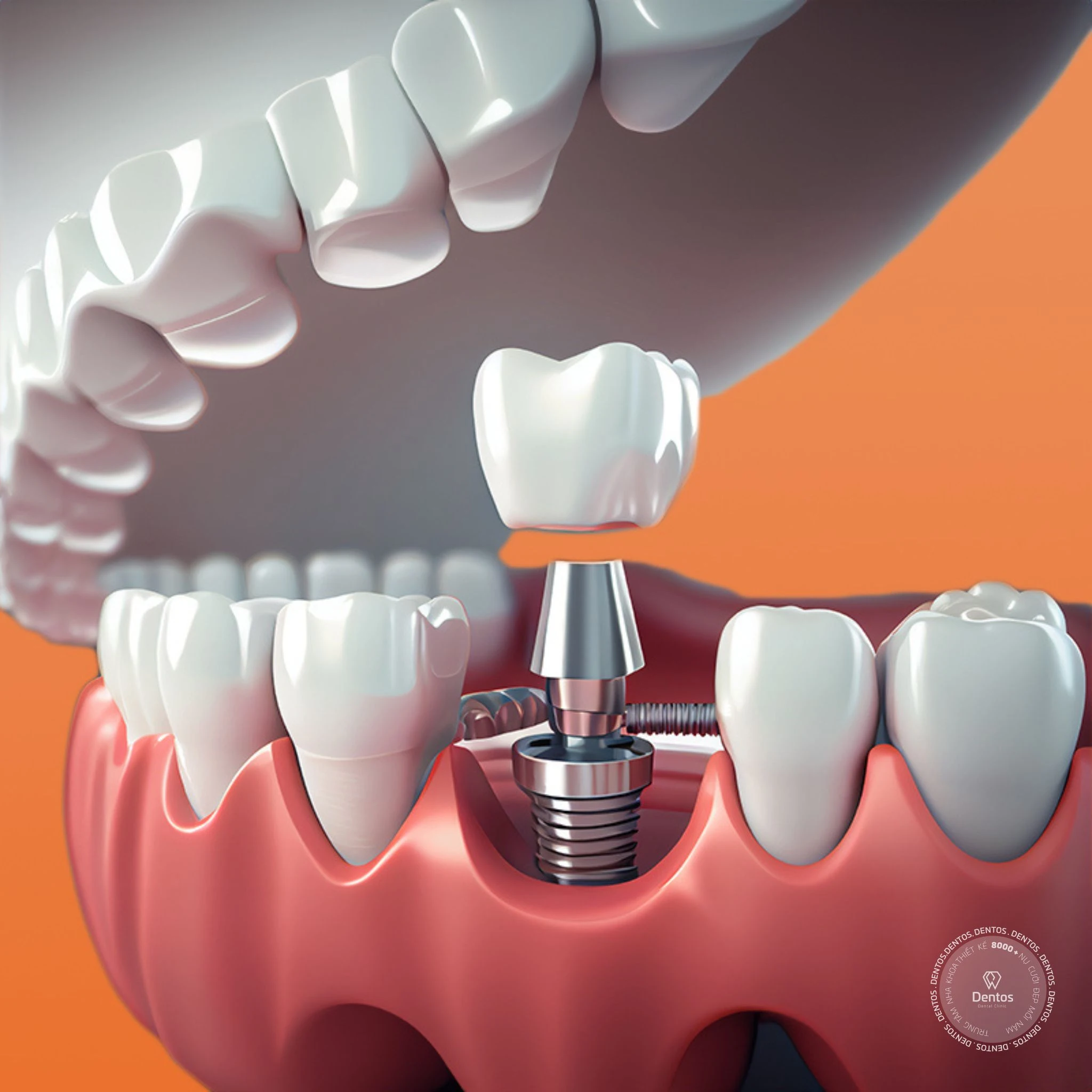 Trồng răng sứ là cấy ghép trụ implant vào xương hàm rồi lắp mão sứ lên trên
