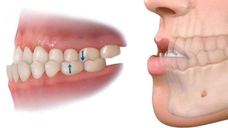Bọc răng sứ chỉ thay đổi hình dáng răng, không can thiệp vào cấu trúc xương hàm