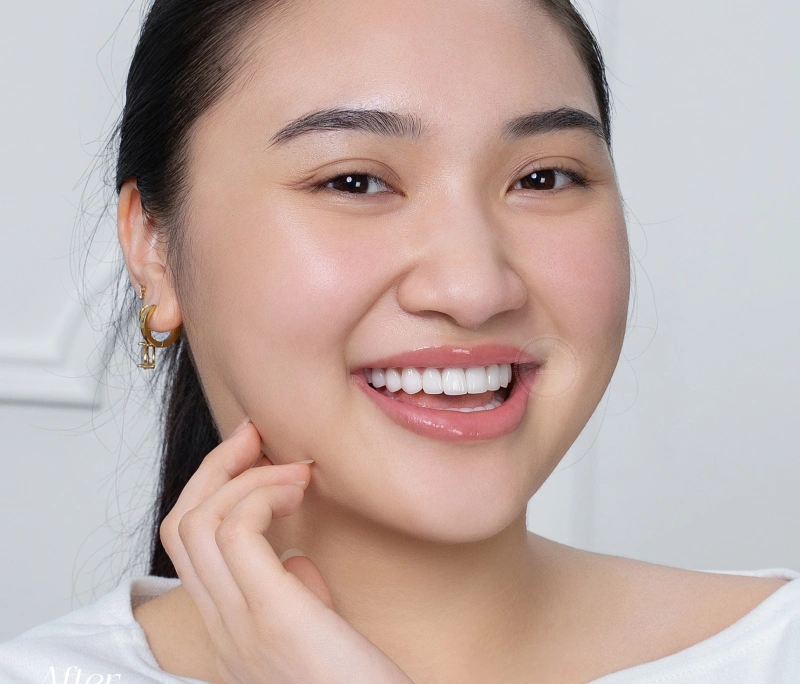 5 câu hỏi quan trọng cần hỏi bác sĩ trước khi bọc răng sứ