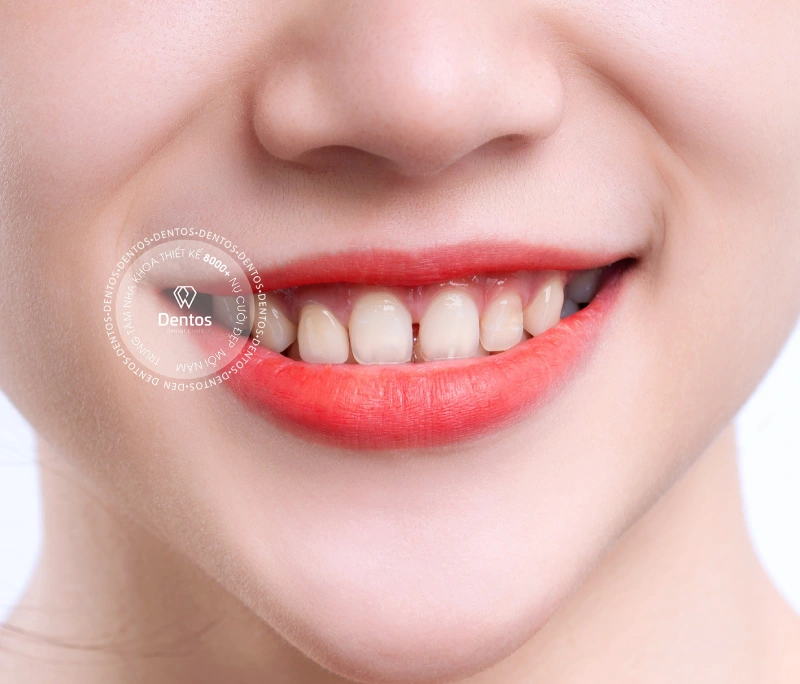 Bọc sứ răng thưa: Giải pháp kiến tạo nụ cười hoàn mỹ sau 2 lần hẹn