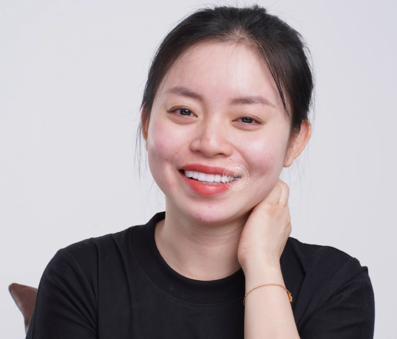 Giá bọc răng sứ ưu đãi: Trọn gói 16 răng chỉ 24 triệu