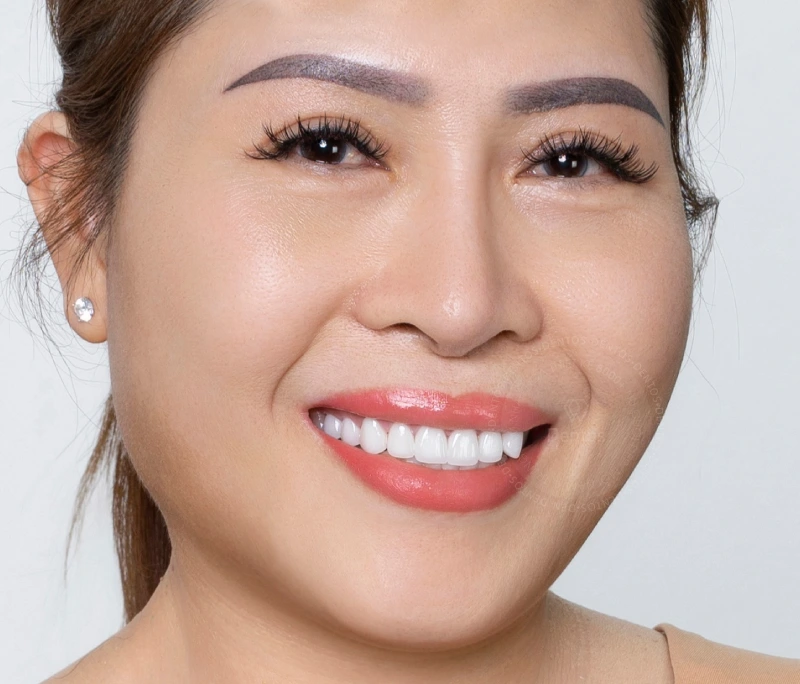 Bọc răng sứ khểnh có làm tổn thương tủy răng không? Nên niềng răng hay bọc sứ?