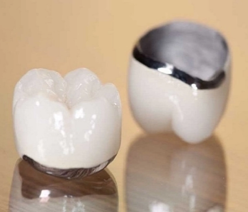 Giái đáp: Tại sao bác sĩ không khuyên làm răng sứ kim loại?