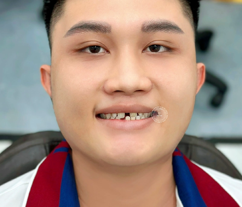 Giải pháp cho người bị mất răng: Lựa chọn nào ngăn ngừa tiêu xương?