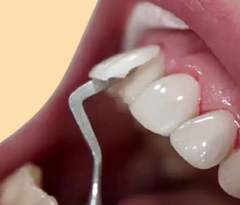 Không ưng dáng răng sứ làm lại được không? Tháo răng sứ có lâu không?