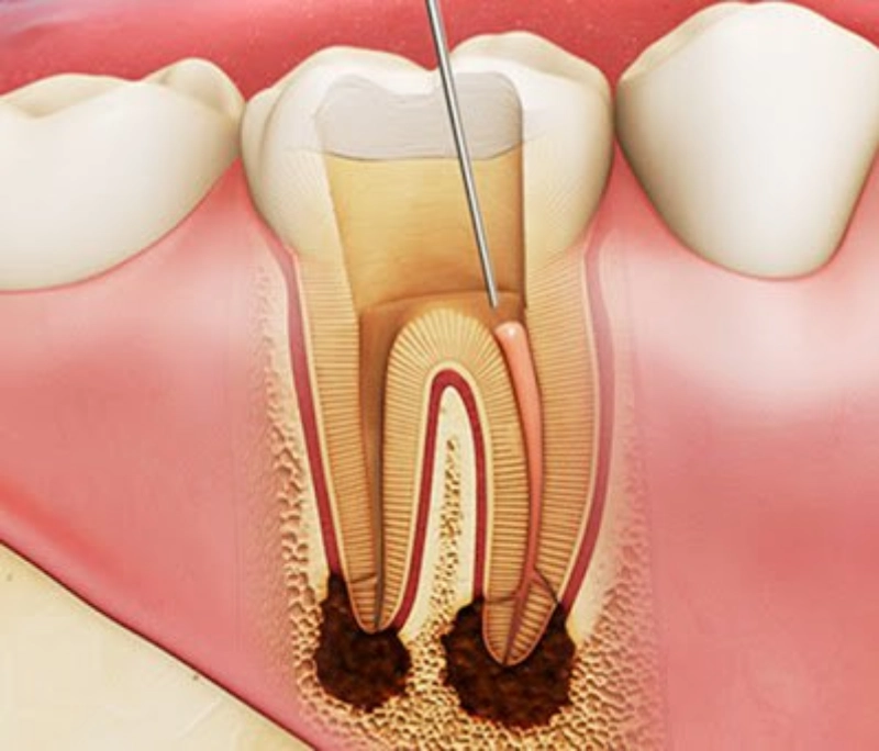 Bọc răng sứ có lấy tủy không? Có đau hay ảnh hưởng gì không?