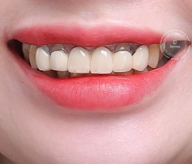 Lời cảnh tỉnh thẩm mỹ răng: Coi chừng hối hận khi làm răng sứ!