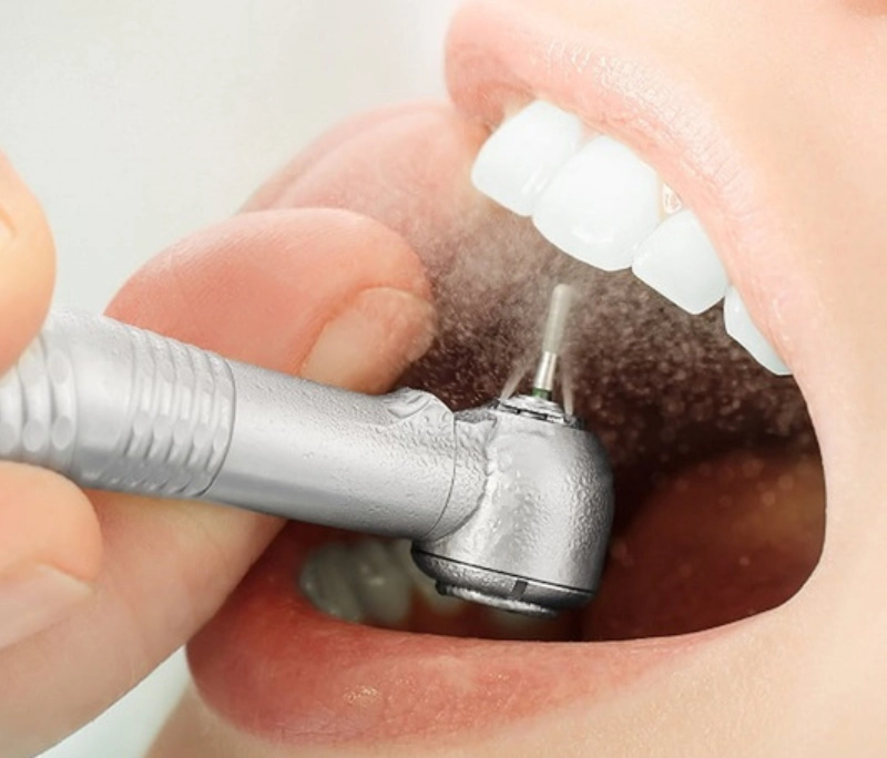 Mài răng bao lâu thì hết ê? Cách giảm ê buốt sau khi mài răng