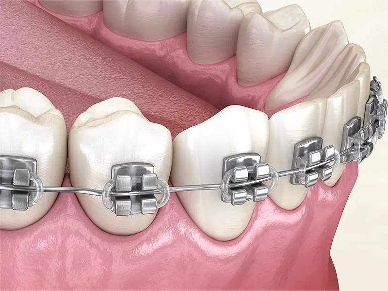 Niềng Răng Mắc Cài Hoạt Động Như Thế Nào? 2