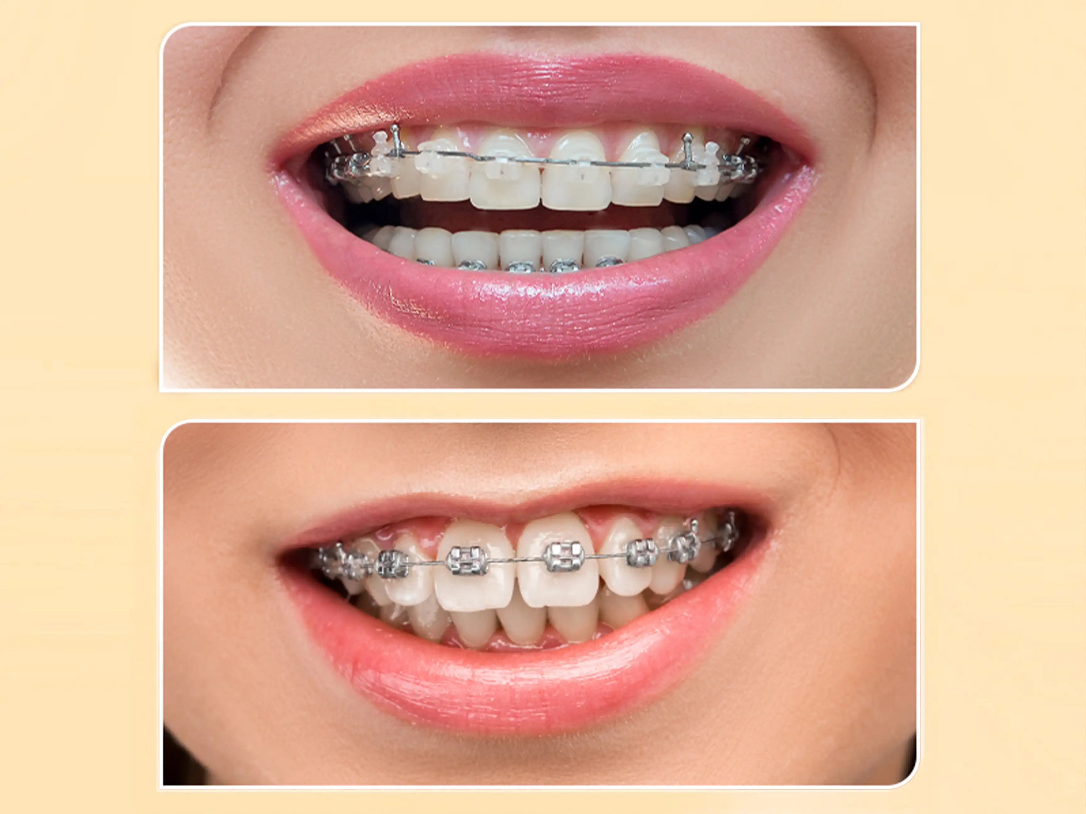 Mắc Cài Sứ vs. Mắc Cài Kim Loại